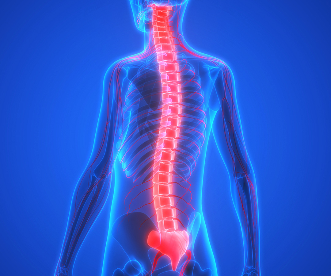 Epidural port kateteri