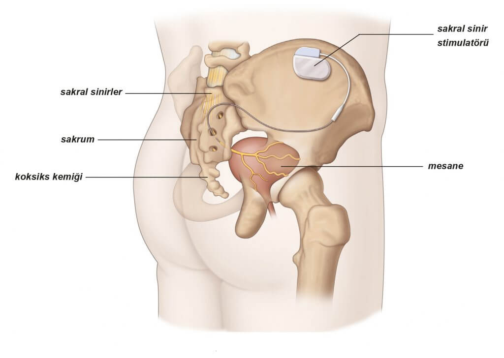 Sakral Neyromodulyasiya